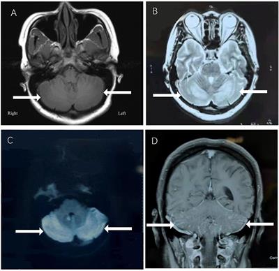 Case Report: A Case of Adult Methylmalonic Acidemia With Bilateral Cerebellar Lesions Caused by a New Mutation in MMACHC Gene